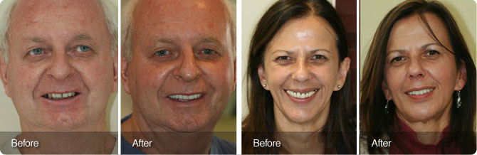 Hahn-Zorica-Immidiate-Loading-Implants