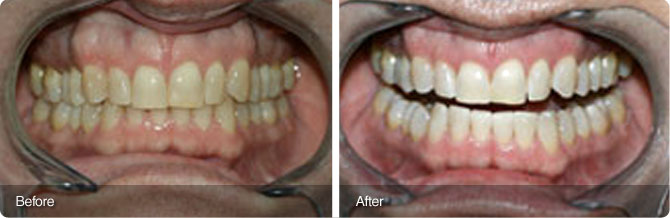 Teeth-Whitening-3 Teeth Whitening Image 2