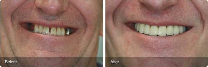 Terry-Immediate-Implants-Loading-