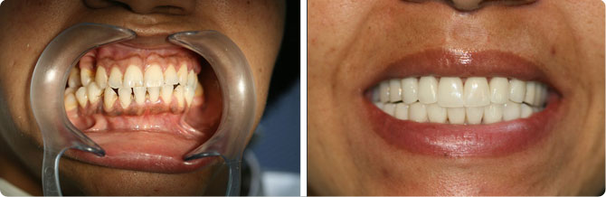 andrea-Full-Ceramic-Crowns