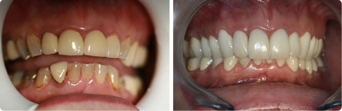 esther-Full-Ceramic-Crowns