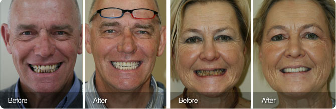 gordon-lydia--Immidiate-Loading-Implants