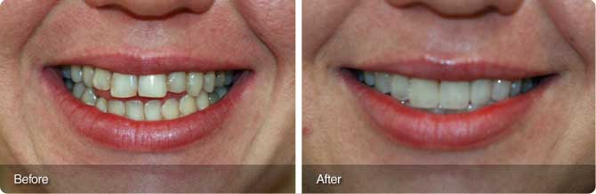 janet-veneers
