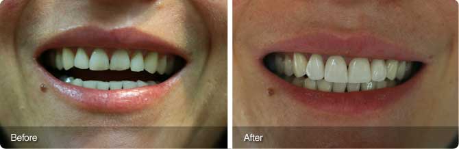 veneers